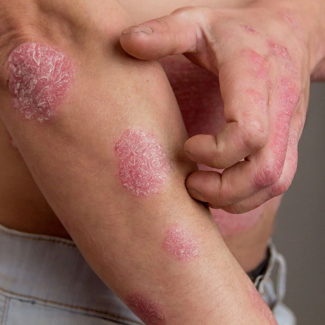 <p>Psoriasis</p>