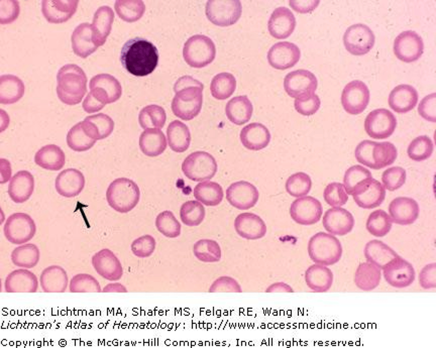 <p>The movement of white blood cells out of capillaries into tissue spaces.</p>