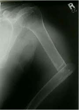 <p>A fracture in which the broken ends of the bone slip past each other and are held in the overlap position by contracted muscles</p>