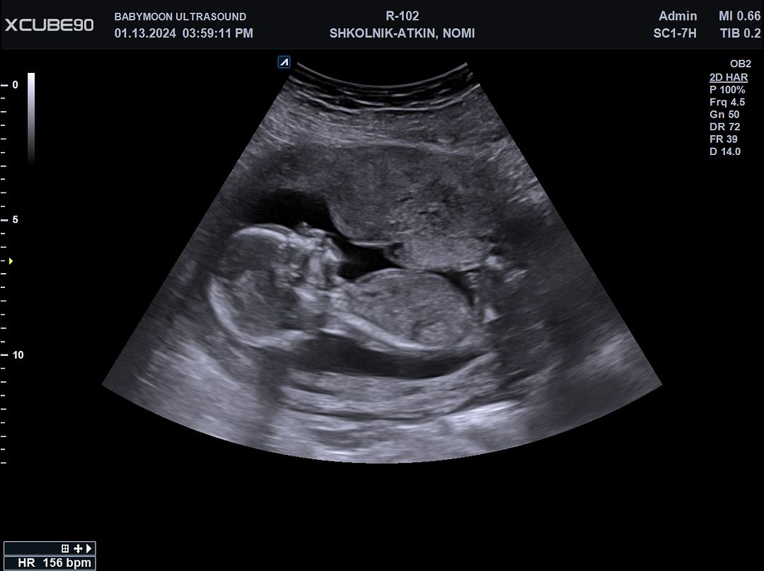 <p><span>Where is the placenta located?</span></p>