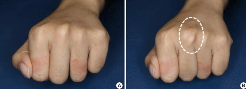 <p><span style="color: rgb(242, 154, 0);"><strong>Zone V/5</strong></span> Extensor Injury: <strong>Sagittal Band Injury</strong></p>