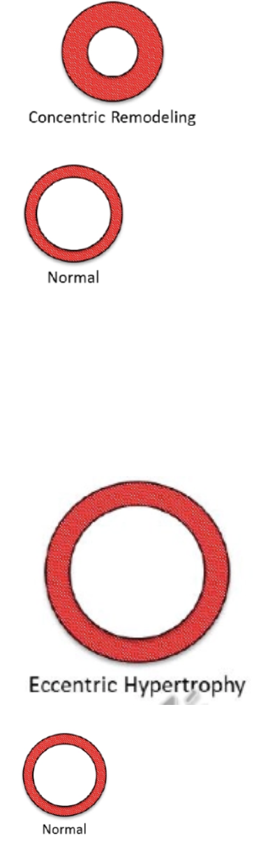 <p><strong>Stenosis</strong> = Narrowing of valve orifice while valve is open</p><ul><li><p>Severity of stenosis is related to pressure gradient</p><ul><li><p>Smaller orifice → Larger pressure gradient → Pressure overload</p></li><li><p>→ Concentric hypertrophy</p></li></ul></li></ul><p><strong>Insufficiency</strong> = Blood flowing through valve in WRONG direction (regurgitation) while valve is “closed”</p><ul><li><p>Severity of insufficiency/regurgitation is related to amount of regurgitant flow</p><ul><li><p>Larger orifice → Greater regurgitant volume → Volume overload</p></li><li><p>Eccentric hypertrophy</p></li></ul></li></ul><p></p>