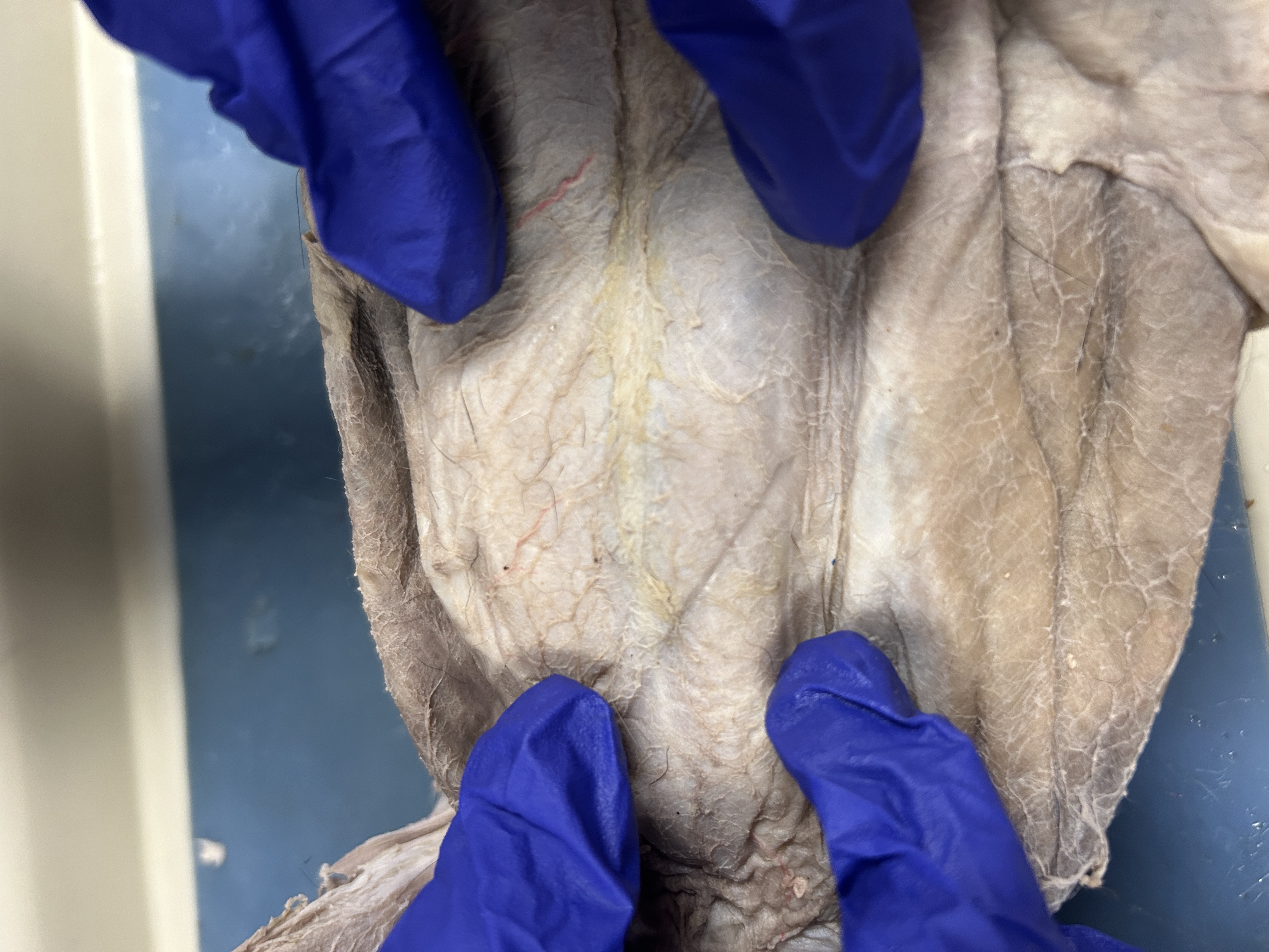 <p>Rectus Abdominis (down side of middle)</p>