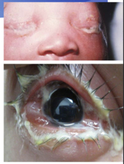 <p>-profuse purulent</p><p>-papillary morphology</p><p>-gram-negative diplococci on culture</p><p>-newborns: ophthalmia neonatorum (rare)</p><p>-inadequate treatment leads to corneal perforation and blindness</p>