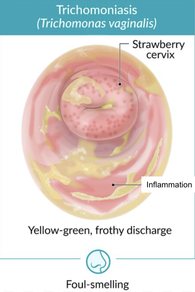 <p>Vaginal discharge</p><ul><li><p>Yellow-green</p></li><li><p>Purulent</p></li><li><p>Frothy</p></li><li><p>Foul-smelling</p></li></ul><p>Vulvovaginal pruritis</p><p>Vaginal burning</p><p>Dyspareunia</p><p>Dysuria</p><p>Strawberry cervix (erythema + petechiae)</p>