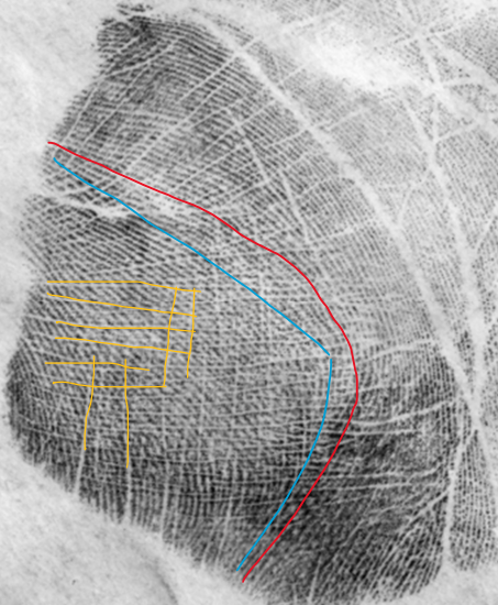 <p>Thenar</p><ul><li><p><span style="color: rgb(253, 0, 122);">Half-moon ridge flow</span></p></li><li><p><span style="color: rgb(0, 146, 255);">Long over short</span></p></li><li><p>Vestige</p></li></ul><ul><li><p><span style="color: rgb(225, 175, 0);">Cross-hatching</span></p></li></ul><p></p>
