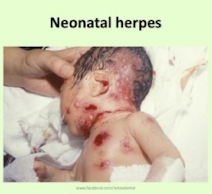 <p><strong>> 85% cases by infection with HSV-2 acquired from maternal genital secretions during delivery;</strong> <span style="color: red;"><strong>severe risk to child if primary infection occurs during 3rd trimester</strong></span></p><p>• C section for women with active lesions and/or positive cultures</p><p><strong><u>3 major patterns of disease</u></strong> (likely a spectrum)</p><ol><li><p><strong>Lesions of skin, eyes, and mouth</strong> (SEM)</p></li><li><p><strong>CNS disease</strong> – encephalitis with/without SEM</p></li><li><p><strong>Disseminated disease </strong>– liver, lungs, CNS (most severe)</p></li></ol><p></p>