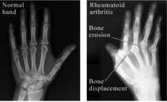 <p>Chronic autoimmune disease which attacks the healthy joint tissue causing inflamed joints</p>