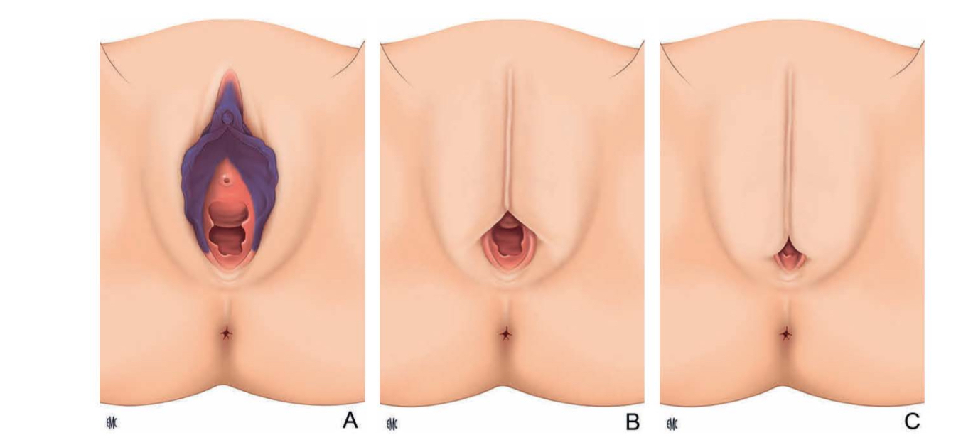 <ul><li><p>infibulation : consiste en un rétrécissement de l’orifice vaginal avec recouvrement cutané</p></li><li><p>Les petites lèvres et/des grandes lèvres sont accolé et le clitoris est parfois excisé</p></li><li><p>C’est la forme la plus extrême, elle représente 15 % des MSF</p></li><li><p>Après section au nom du clitoris et des petites lèvres, les grandes lèvres sont réséqué puis cousus entre elles ou accolé en liant les membres inférieurs pendant plusieurs semaines</p></li><li><p>Seul un petit orifice est maintenu grâce à l’insertion d’un morceau de bois dans la plaie atteint de permettre les commandes des urines et des menstruations</p></li><li><p>Lors du premier rapport sexuel la cigarette doit être réouverte, après un accouchement il n’est pas rare que la femme soit recousu</p></li></ul><p></p>