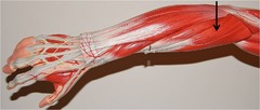 <p>most likely muscle involved with lateral epidondylitis</p>