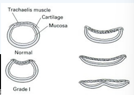 <p>Weakening of C-shaped tracheal rings and dorsal membrane </p>