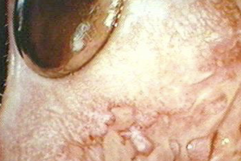 <p>Hold patient’s tongue, cheek or lip to prevent interference or protection</p>