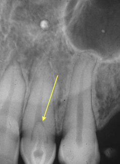 <p>deep surface enamel invagination of the crown or root “tooth within tooth”; can be coronal (most frequent) or radicular</p>