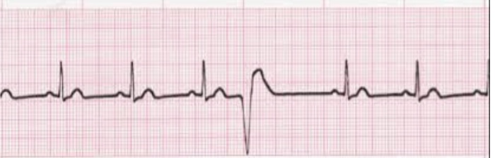 <p>What is this EKG showing?</p>