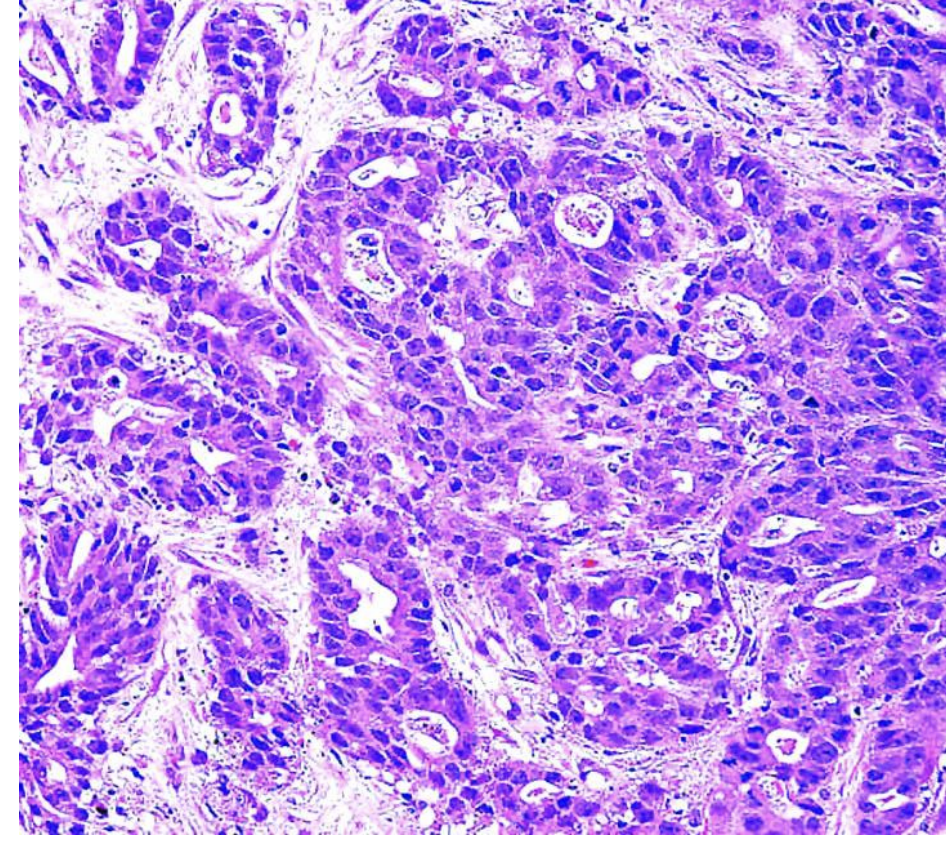 <p>diagnosis, esophageal tumor</p>