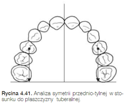 <p>Do oceny symetrii przednio-tylnej stosuje się linie referencyjna:</p><p>prostopadłą do linii szwu podniebiennego i</p><p>przebiegającą przez najbardziej do tyłu położone punkty guzowatości szczęki</p>