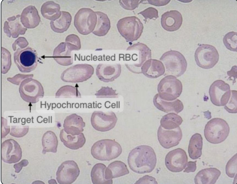 <p>What anemia does this peripheral blood smear indicate? What is another name for nucleated red blood cells? Why are they in the peripheral blood here?</p>