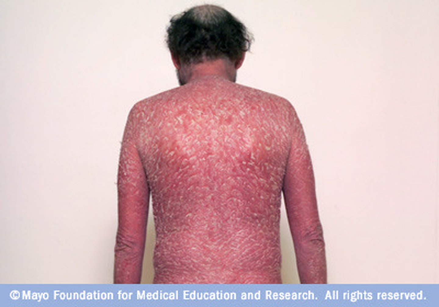 <p>- erythema with scale covering most of body</p><p>- impairs normal function of skin</p><p>- evaluate for systemic features</p>