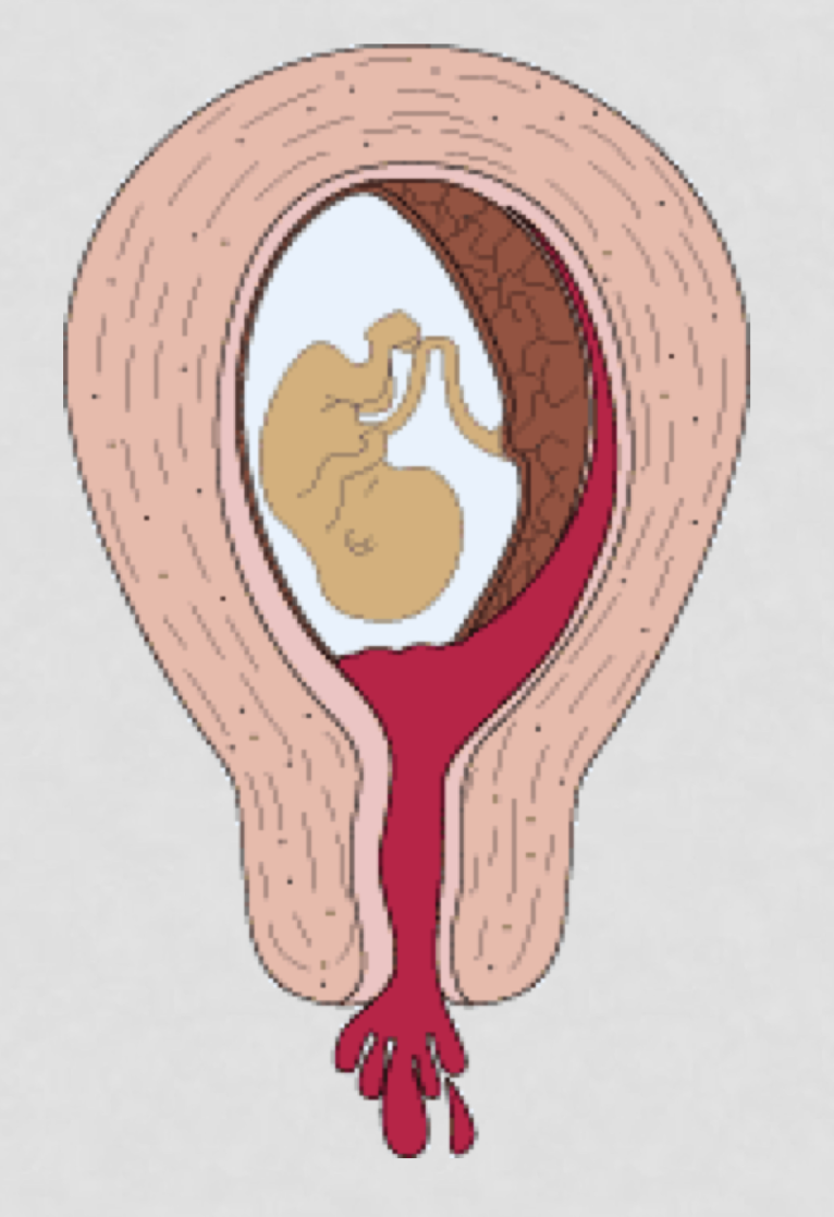 <ul><li><p>Moderate to heavy bleeding with presence of tissue </p></li><li><p>Mild to severe cramping </p></li><li><p>Cervical dilation </p></li><li><p>ROM</p></li><li><p>Passage of products of conception (POC) inevitable </p></li></ul><p></p>