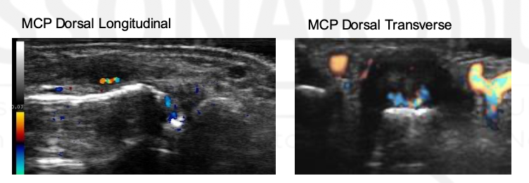 <p>Peri-extensor tendinitis is seen here. Not common in RA. Why? Because RA is a primarily synovial disease.</p><p>How does US compare to MRI with extensor tendinitis?</p>