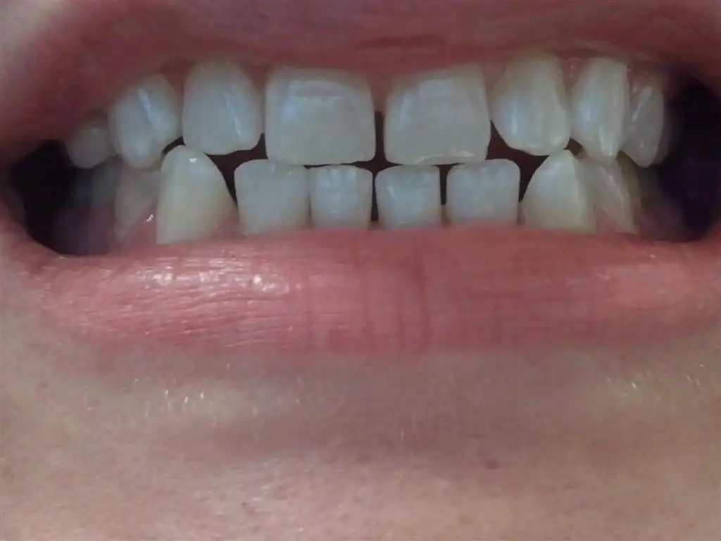 <p>Tooth number 7 and 27, &amp; 10 and 22 are in what relation to one another?</p>