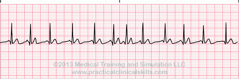 <p>Rate: >100</p><p>Regularity: irregularly irregular </p><p>At least 3 different P wave morphologies </p>