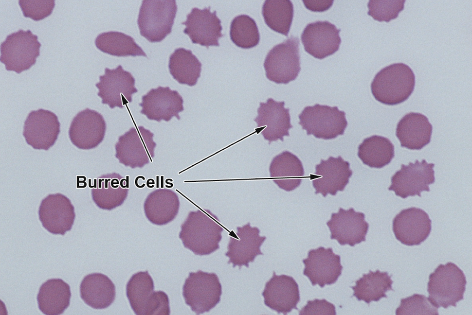 <p>Burr cell anemia </p>