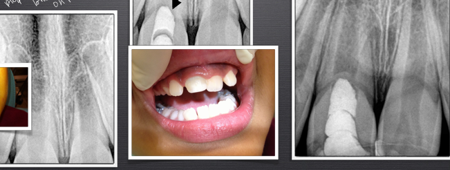 <p>-vital pulp therapy performed to encourage continued physiological root development and apical closure</p><p>-do a pulpotomy by taking out coronal pulp tissue and placing bioceramic cement on pulp stump</p><p>-takes ~24-36 hours for bioceramic cement to set- does not irritate the pulp, medically seals the pulp from contaminatory saliva</p><p>-over 6-8 months, bring patient back for recall</p><p>-calcific bridge should form from immune competent cells → rest of root able to develop</p><p>-helps to preserve ridge</p>