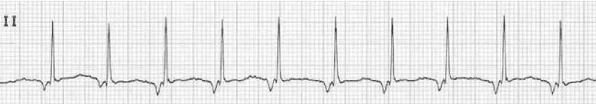 <p>Rate: 60-100</p><p>Regularity: regular</p><p>P waves are either absent, in QRS, after QRS, or inverted before QRS</p>