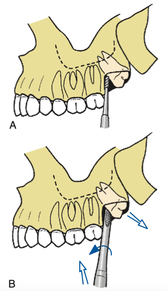 <p>easier for maxillary</p><p>crown angled distally; withdrawal path generally accessible</p>
