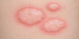 <p>Edema dérmico transitorio, elevado, pruriginoso y blanqueable</p>