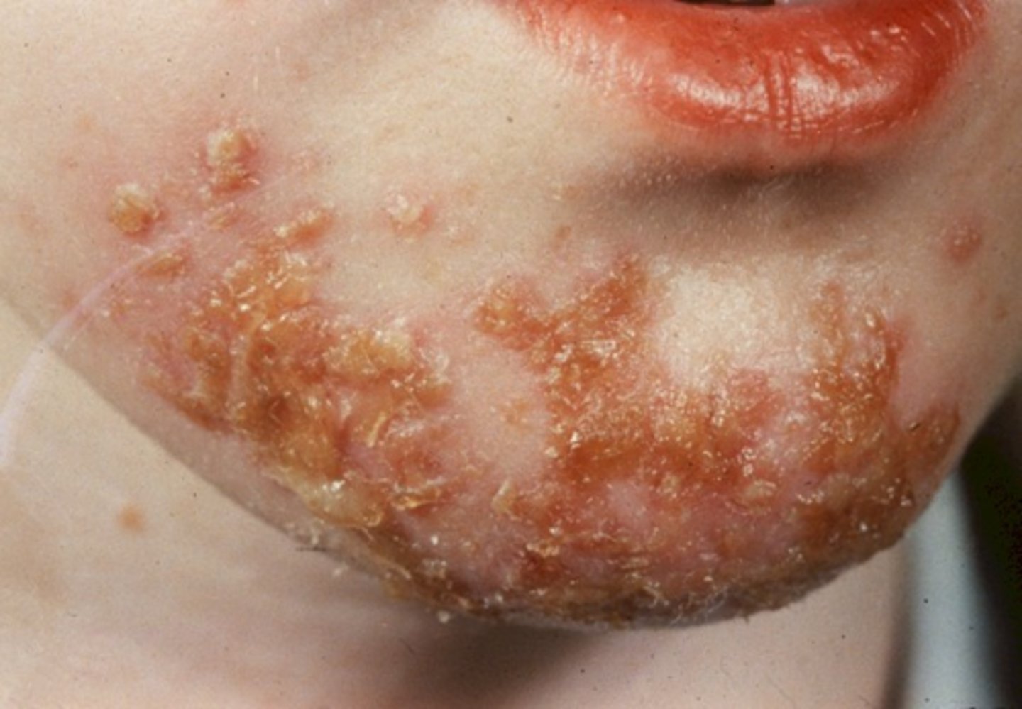 <p>infection d/t bacteria</p><p>-appears bulbous or crusty and yellowed with some pus</p><p>-honey crusted, yellow</p>