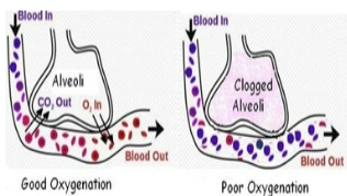 <p>ventilation (V) / perfusion (Q)</p><p><u>physiologic shunting:</u> area is ventilated but alveoli has limited gas exchange</p>