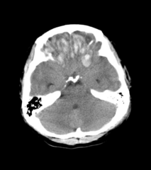 <p>- Usually hemorrhage with surrounding edema</p><p>- May cause traumatic sub-arachnoid hemorrhage</p><p>- Cause broad spectrum of neurological dysfunction</p><p>- May cause increased intracranial pressure</p>