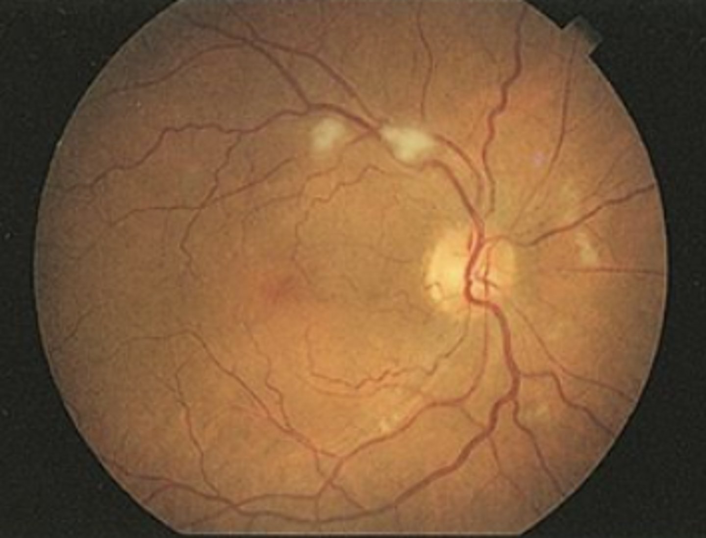 <p>Cotton-wool spots are white or grayish, ovoid lesions caused by microinfarcts of the retinal nerve fiber layer.</p><p>Result from extruded axoplasm from retinal ganglion cells and are seen in conditions such as hypertension, diabetes, HIV, and other viruses.</p>