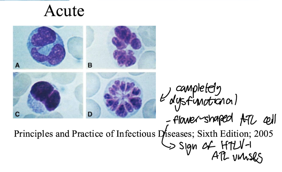 <p><strong>Characteristic ‘flower-like’ cells with a large nucleus-to-cytoplasm ratio, prominent atypia, and irregular shapes. </strong></p><ul><li><p><strong>Exhibit significant pleomorphism with varying sizes and nuclear characteristics </strong><span style="color: purple;"><strong>i.e. indentations</strong></span></p></li><li><p><strong>Cells are completely dysfunctional</strong></p></li><li><p><strong>Key initial sign of ATL caused by HTLV-1, indicating chance of malignancy and aggressive behavior. </strong></p></li></ul><img src="https://assets.knowt.com/user-attachments/89f6f90b-ec13-41b0-9254-0ea3fec79a63.png" data-width="75%" data-align="center"><p></p>