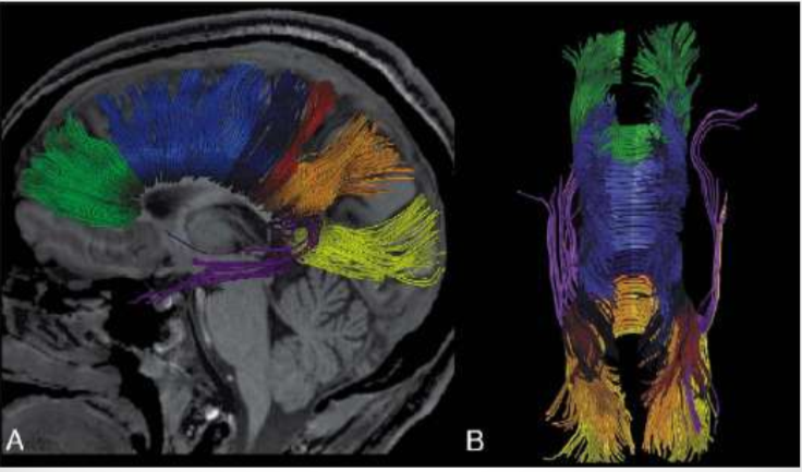 <p>Early DTI images. Color superimposed on images</p>
