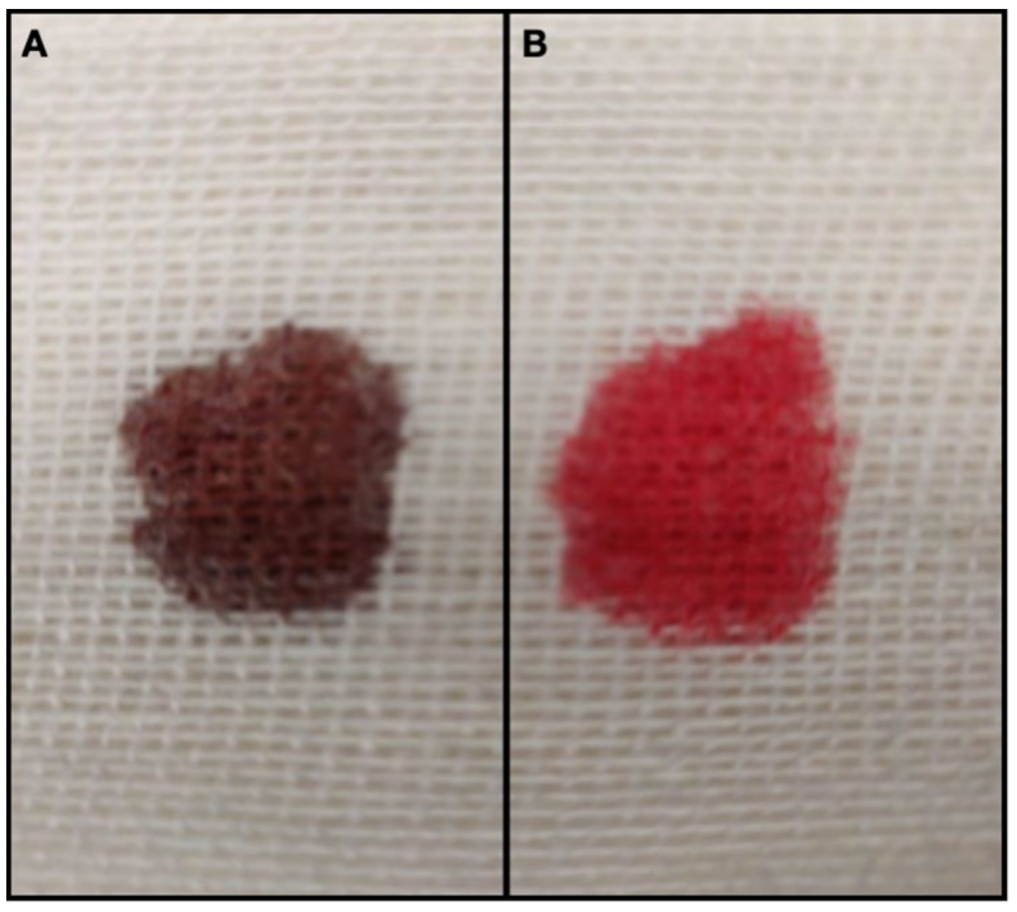 <p>Methemoglobin</p>