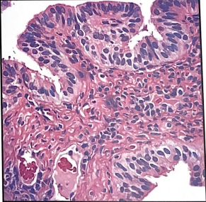 <p>That fixation was most likely incomplete is indicated in this image by the: a. 3 shades of eosin b. smudgy nuclei c. bright pink collagen d. pale epithelial cytoplasm</p>