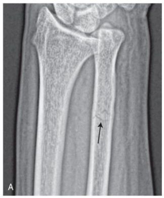 <p>direction of fracture line</p>