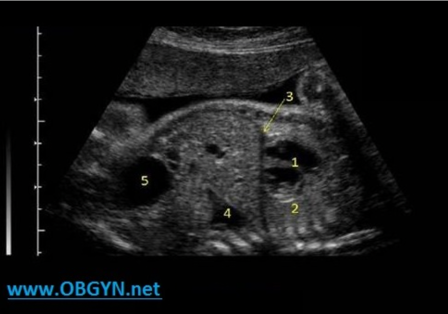 <p>#4 represents what fetal structure?</p><p>A. urinary bladder</p><p class="p1">B. stomach</p><p class="p1">C. lung tissue</p><p class="p1">D. hydronephrosis</p>