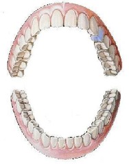 <p>maxillary left first bicuspid</p>