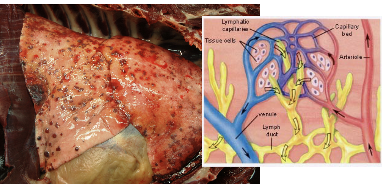 <p>Tumor cells entering the <strong>venous circulation encounter the pulmonary capillary bed</strong>, making the lung an important site where circulating tumor cells can lodge</p><ul><li><p>Venous blood → right heart → lungs → pulmonary capillaries → tumor cells lodge</p></li></ul><p></p>