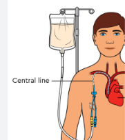 <p>Solution of nutrients is administered directly into the blood stream</p>