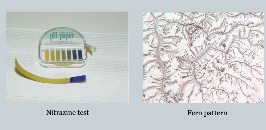 <ul><li><p>watery vaginal discharge</p></li><li><p>visual pooling of clear fluid in the posterior fornix of the vagina or leakage of fluid from the cervical area</p></li><li><p>an alkaline pH of th cervicovagial discharge, which is tyically demonstrated by seeing whether the discharge turns yellow nitrazine paper to blue (nitrazine test)</p></li><li><p>microscopic ferning of the cervicovaginal discharge on drying</p></li><li><p>evidence of diminished amniotic fluid</p></li></ul><p></p>