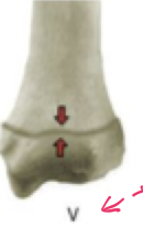 <p><em>The physis that is most susceptible to premature closure secondary to compaction is which one?</em></p>