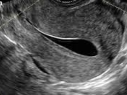 <ul><li><p>structural anatomy</p><ul><li><p>uterine shape, check for masses</p></li></ul></li><li><p>endometrium</p><ul><li><p>thickness + echogenicity</p></li></ul></li><li><p>ovaries</p><ul><li><p>presence and number of follicles</p></li><li><p>presence of cysts for other pathology</p></li></ul></li><li><p>fallopian tubes</p><ul><li><p>Patency - can confirm w/:</p><ul><li><p>hyterosalpingogram (xray)</p></li><li><p>sonohysterogram / saline infused sonogram (SIS)</p></li></ul></li></ul></li></ul><p></p>