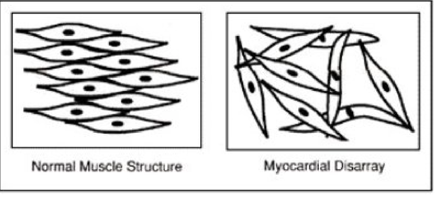 <p>Compare normal muscle structure to myocardial disarray.</p>