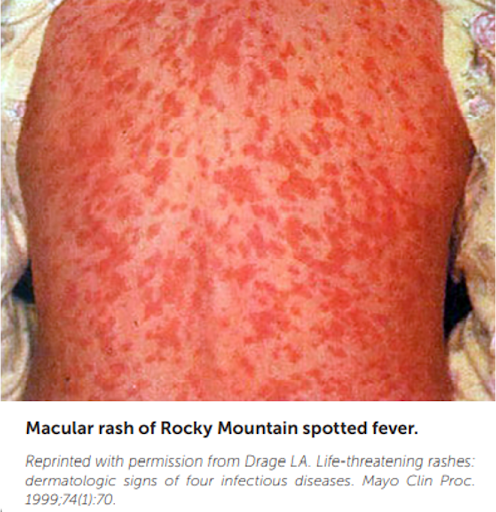 <p>rapidly progressing small vasculitis = ?</p>