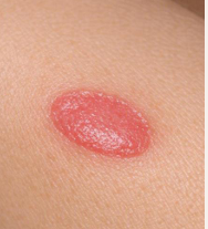 <p>Epidermis · húmeda · sin cicatriz</p>